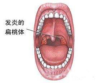 敦睦堂徐氏®告诉您：扁桃体炎饮食上有哪些禁忌